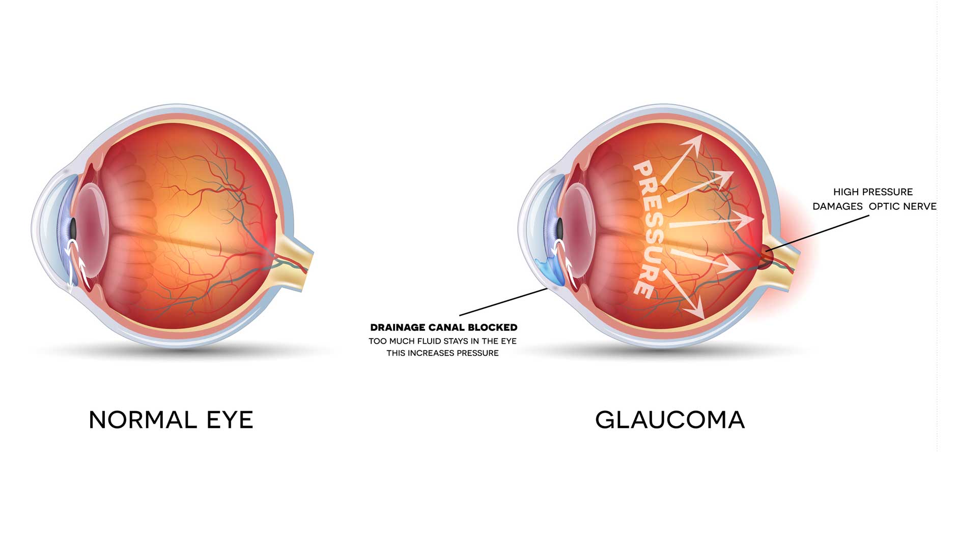 prognostic pentru vedere în glaucom
